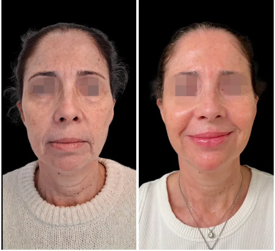 Antes y después de armonización facial caso 2, perspectiva principal