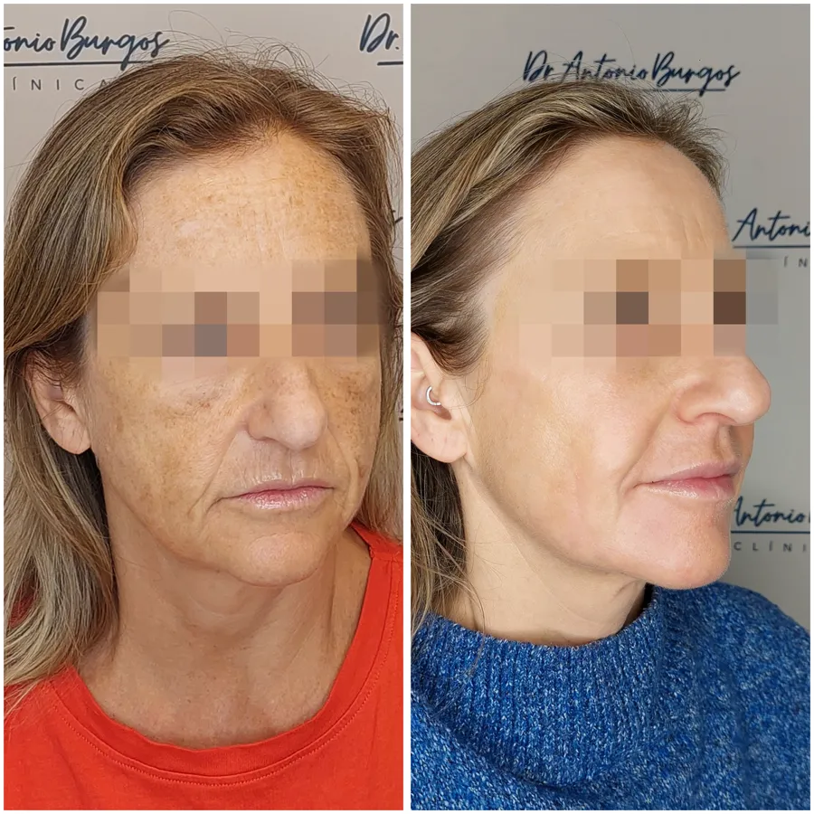Antes y después de tratamiento de flacidez caso 2, perspectiva 2
