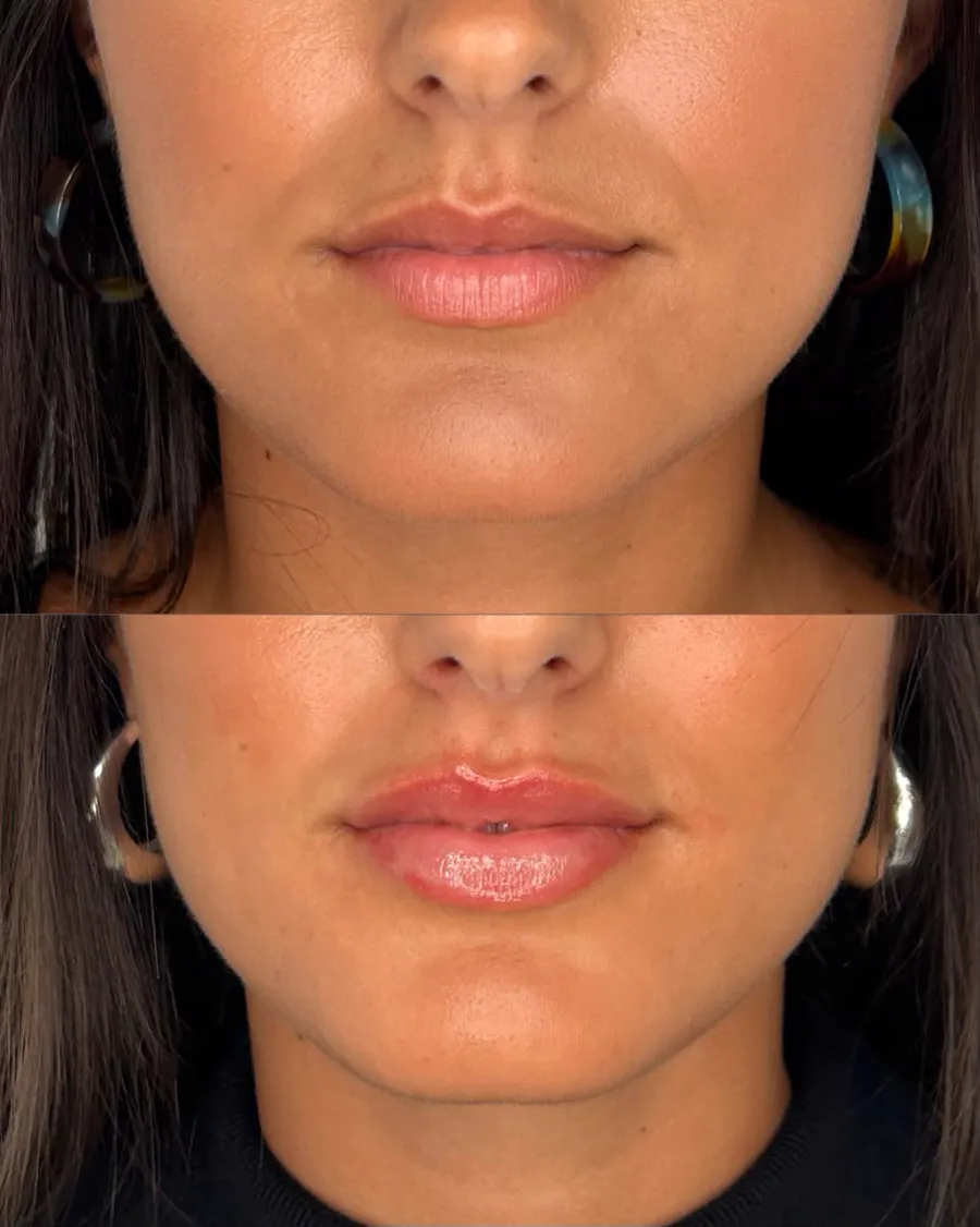 Antes y después de relleno labial en mujer joven