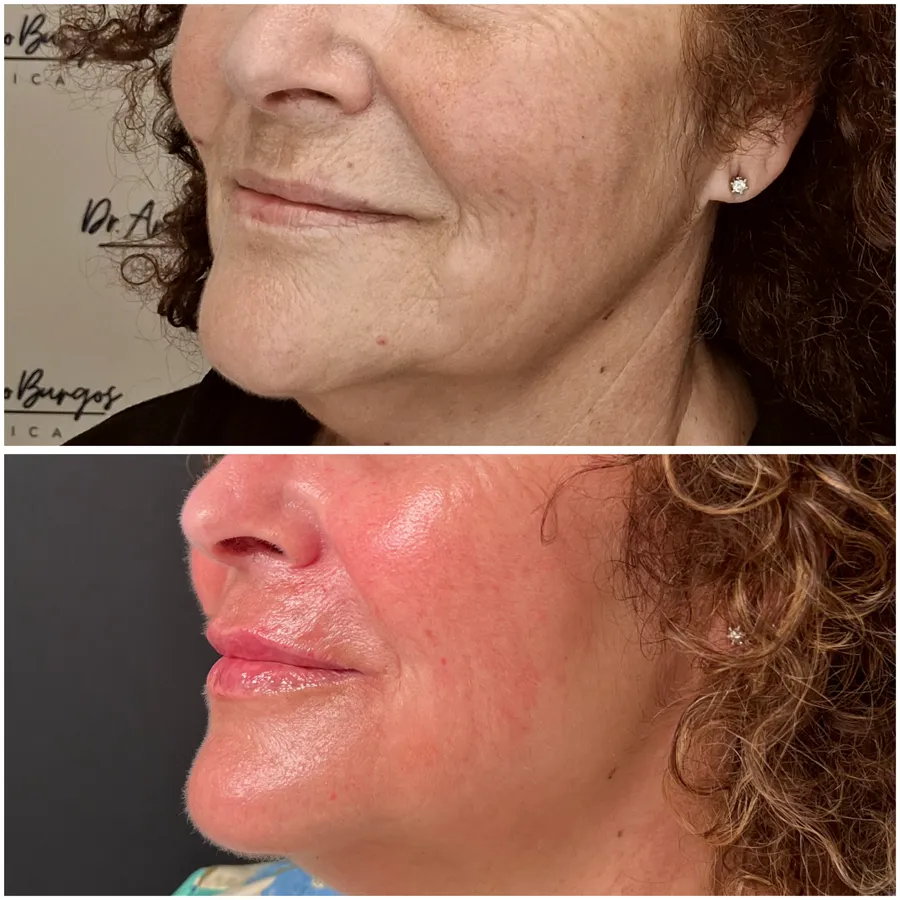 Antes y después de relleno labial en mujer madura, ángulo 1