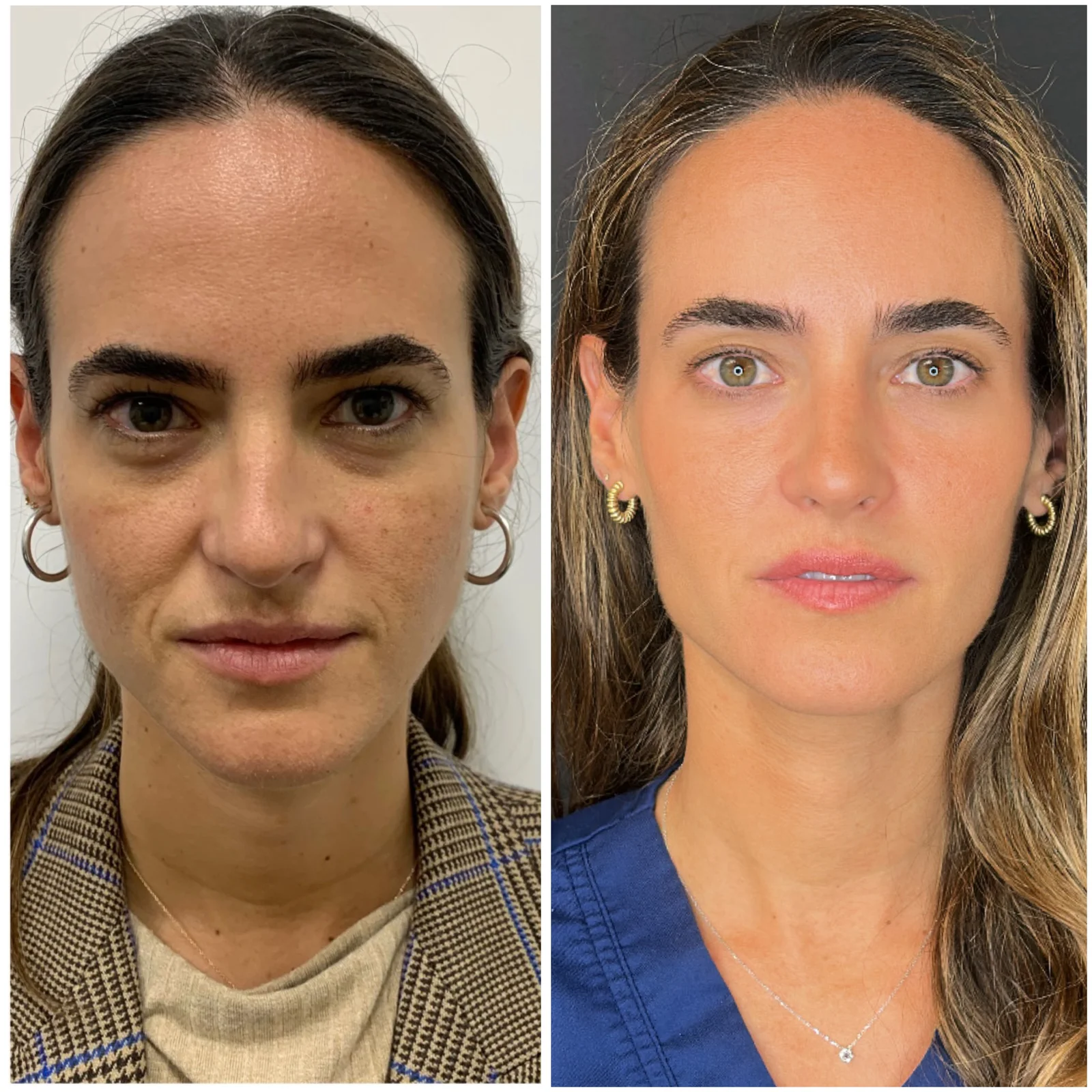 Sandra antes y después del tratamiento en Clínica Dr. Antonio Burgos